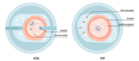 Schemazeichnung, die den Ablauf einer IVF- und ICSI-Behandlung veranschaulicht.