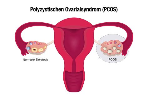 Schema der Eierstockfunktion bei PCO-Syndrom
