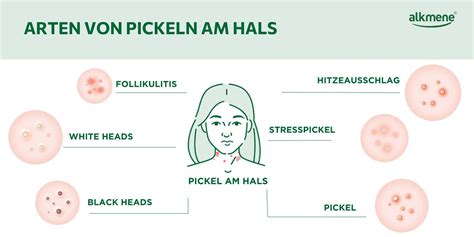 Illustration, die die negativen Auswirkungen des Ausdrückens von Pickeln zeigt: Verbreitung von Bakterien, Entzündung und Narbenbildung.