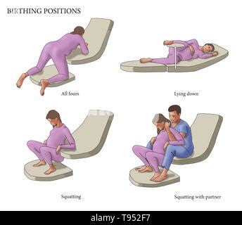 Grafik mit verschiedenen Geburtspositionen