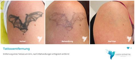 Vergleichsgrafik: Risiken von Tattooentfernung vs. unbedenkliche Fake-Tattoos für den Babybauch.