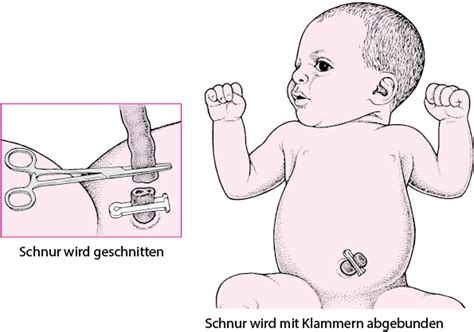 Infografik: Vergleich von frühem und spätem Abklemmen der Nabelschnur