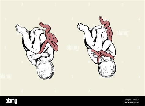 Illustration einer Nabelschnurumschlingung um den Hals eines Babys