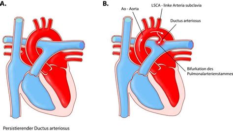 Schema des persistierenden Ductus arteriosus (PDA) bei Frühgeborenen