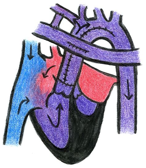 Schema der Fontan-Zirkulation