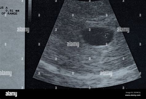 Ultraschallbild eines frühen Embryos mit und ohne Herzschlag