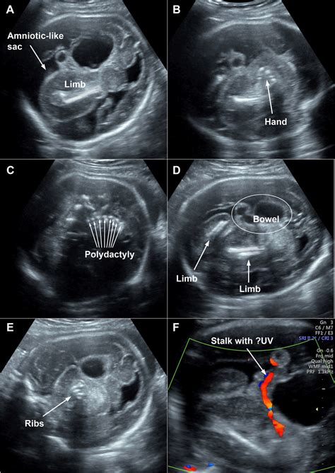 Schematische Darstellung eines Fetus in Fetu im Bauchraum