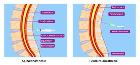 Schema der Kombinierten Spinal- und Epiduralanästhesie (CSE)
