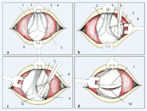 Infografik zur postoperativen Schmerztherapie nach Sectio Caesarea